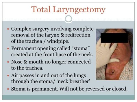 total laryngectomy vula
